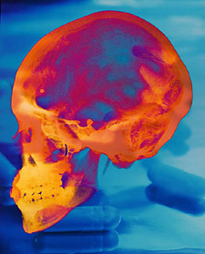 Thermal Image of Skull